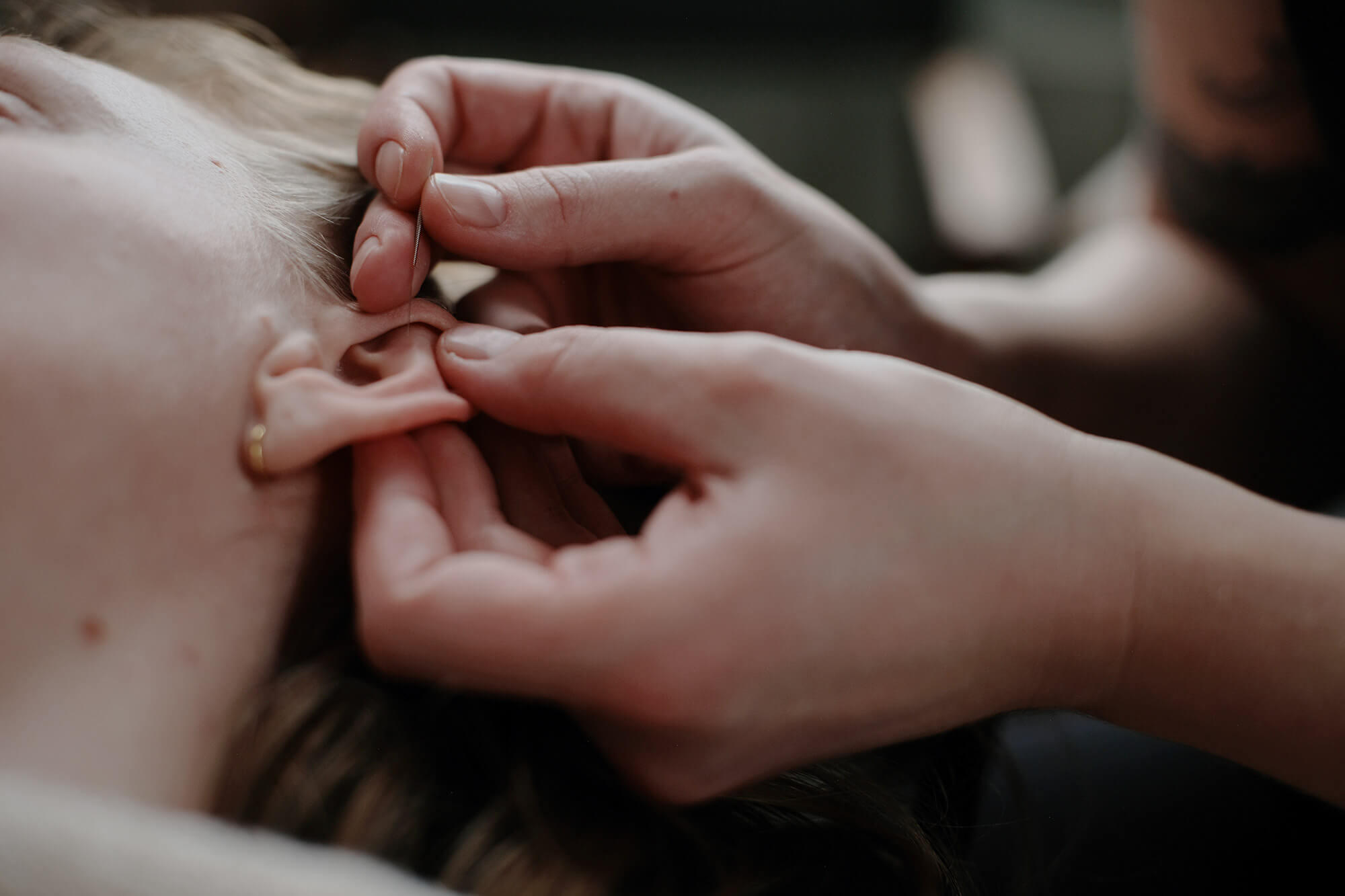 Øreakupunktur udført professionelt og med stor ekspertise